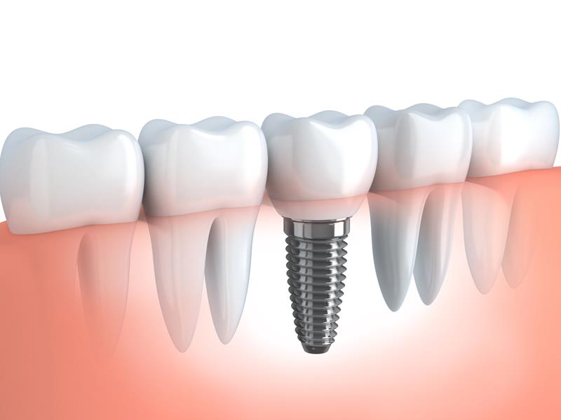 Dental Implants  Farmington Hills, MI 